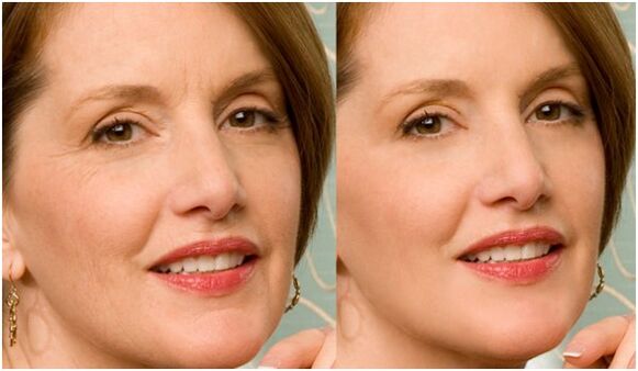 avant et après le rajeunissement de la peau du visage au plasma