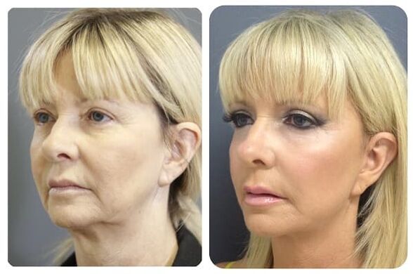 avant et après rajeunissement de la peau avec raffermissement photo 2
